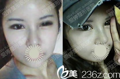 我在韩国爱婷整形外科双眼皮和隆鼻7天照