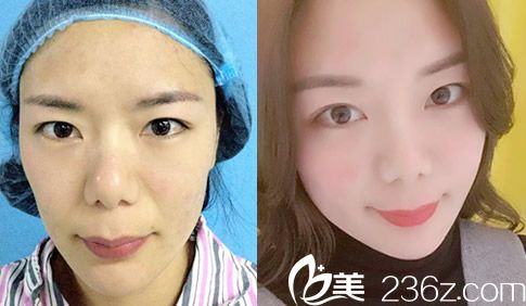 叶凡自体脂肪填充全脸案例效果对比图 叶凡自体脂肪填充全脸案例效果对比图
