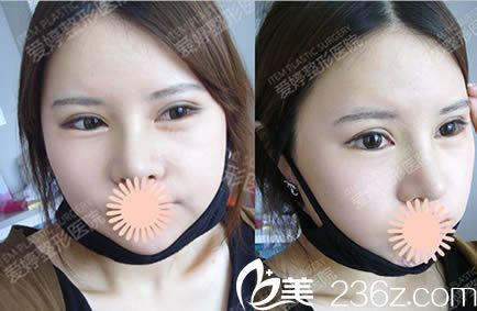 韩国爱婷整形假体隆鼻和磨颧骨一个月照 韩国爱婷整形假体隆鼻和磨颧骨一个月照