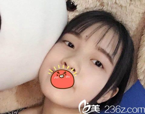 在金华瑞丽整形做双眼皮前 在金华瑞丽整形做双眼皮前