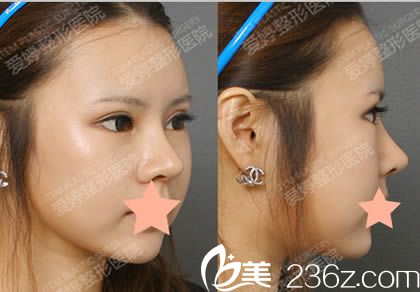韩国爱婷整形医院做双眼皮修复+无疤痕隆鼻+磨颧骨三个月照 韩国爱婷整形医院做双眼皮修复+无疤痕隆鼻+磨颧骨三个月照