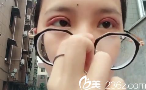 在金华瑞丽做双眼皮3天后 在金华瑞丽做双眼皮3天后