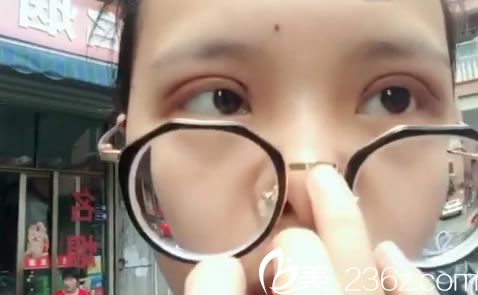 选择金华瑞丽刘政割双眼皮7天效果 选择金华瑞丽刘政割双眼皮7天效果