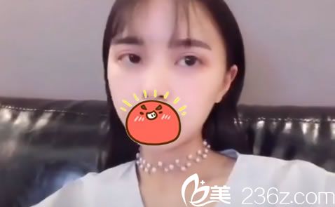 做完双眼皮手术19天恢复照 做完双眼皮手术19天恢复照