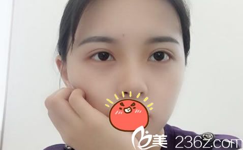 相信看了我在金华瑞丽找刘政院长做双眼皮和开眼角的恢复效果,你也会想割双眼皮的