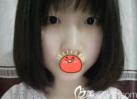 在宁波雅韩做双眼皮手术前 在宁波雅韩做双眼皮手术前