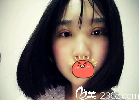 做完双眼皮手术2天后恢复照 做完双眼皮手术2天后恢复照