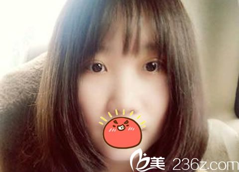 双眼皮手术7天拆线效果 双眼皮手术7天拆线效果