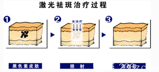 激光祛斑治疗过程示意图