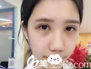 术后18天眼睛已经消肿 术后18天眼睛已经消肿