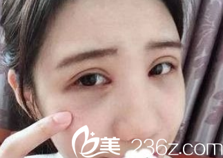 术后双眼皮微肿眼袋消除 术后双眼皮微肿眼袋消除