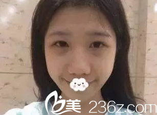 术前内双眼睛+眼袋 术前内双眼睛+眼袋