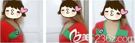上海star美自体脂肪隆胸真人案例术前照