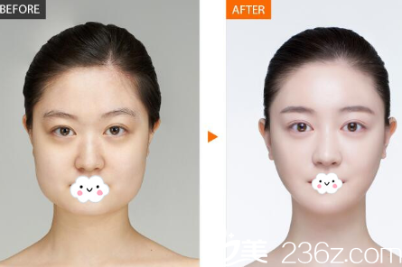 莱芜艾美医疗美容诊所注射瘦脸除皱瘦脸案例图