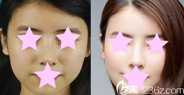 自体肋软骨隆鼻代表案例