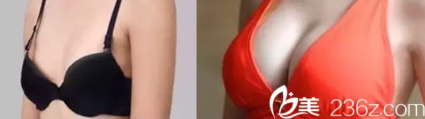 珠海科美胸部整形代表案例