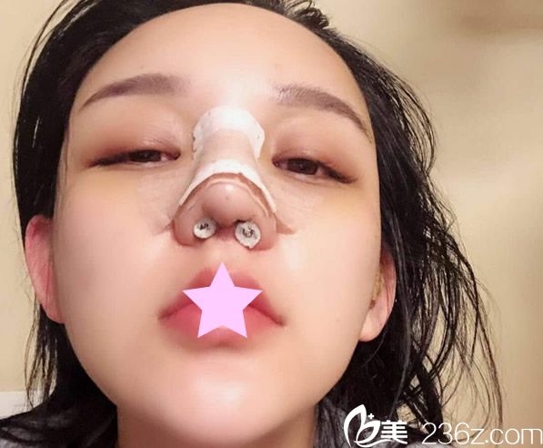 华美鼻综合术后1至7天的我