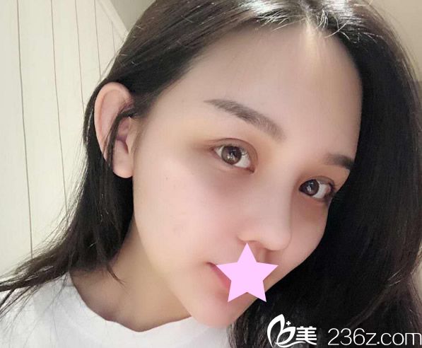 全脸脂肪填充半个月效果