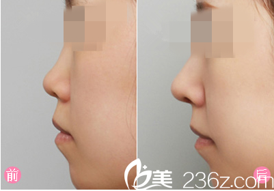膨体隆鼻手术前后对比图