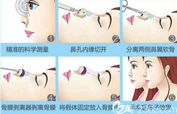 膨体隆鼻手术原理