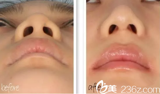 膨体隆鼻前后对比