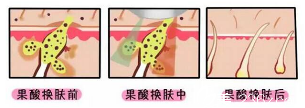 果酸换肤原理图解