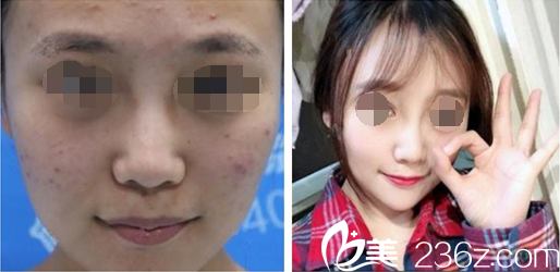 果酸换肤案例对比图