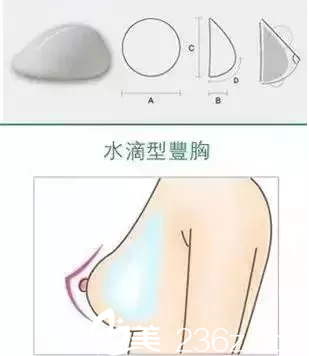 水滴形假体隆胸效果特点