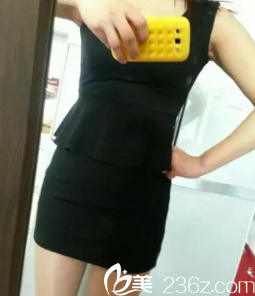 术后30天腰部明显变瘦 术后30天腰部明显变瘦