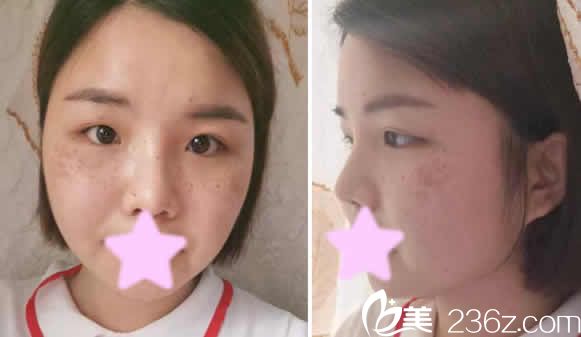 我在太原华美整形医院做超皮秒祛斑前照片 我在太原华美整形医院做超皮秒祛斑前照片