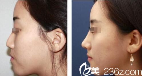 韩国鼻整形医生金翰成达拉斯隆鼻案例