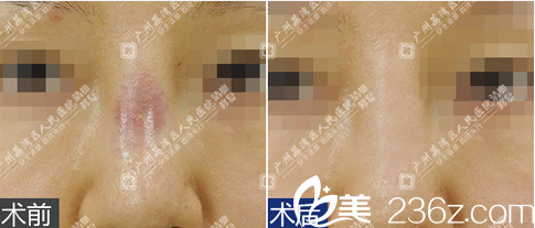 广州荔湾医院奥美定打过的鼻子图片与取出鼻子奥美定的图片对比