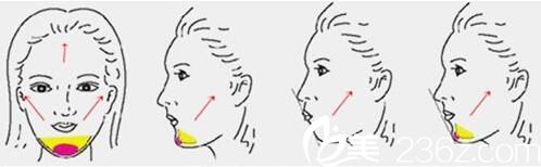 射频除皱消除面部皱纹