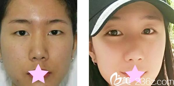 呼和浩特大韩整形割双眼皮前 呼和浩特大韩整形割双眼皮前