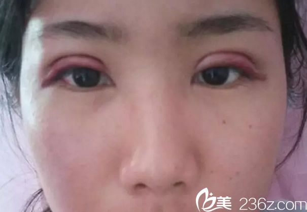 全切双眼皮天眼睛很肿 全切双眼皮天眼睛很肿