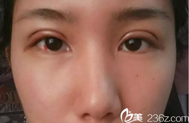 割双眼皮第五天 割双眼皮第五天