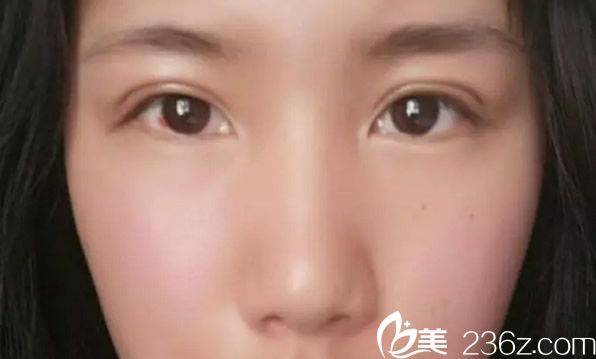 全切双眼皮七天拆线 全切双眼皮七天拆线