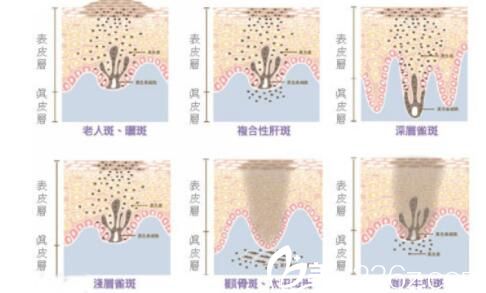 激光祛斑会留疤吗？