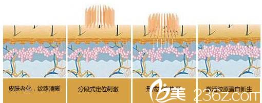激光去妊娠纹原理