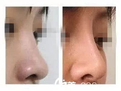 膨体隆鼻术后对比效果