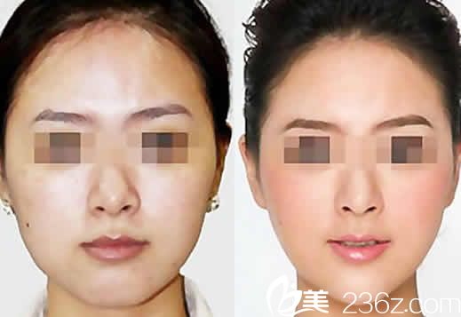 太原欧美莲白立明面部线雕效果图