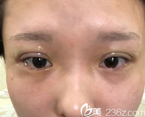 刚做完埋线双眼皮手术的图片