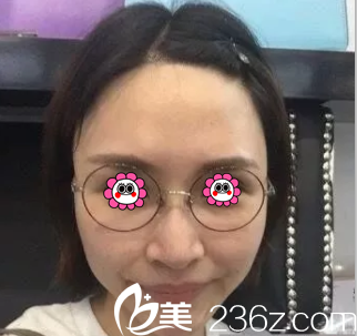 在北京美莱做面部线雕前样子 在北京美莱做面部线雕前样子