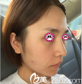 在北京美莱做埋线提升第3天效果 在北京美莱做埋线提升第3天效果