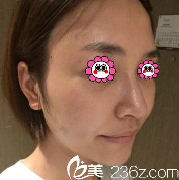 北京美莱赵峻贤给我做面部线雕第11天效果 北京美莱赵峻贤给我做面部线雕第11天效果