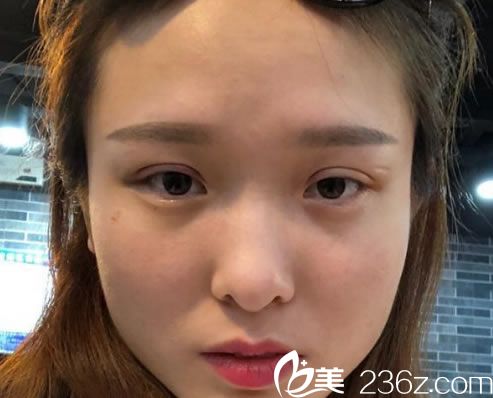 埋线双眼皮手术3天恢复<span style=