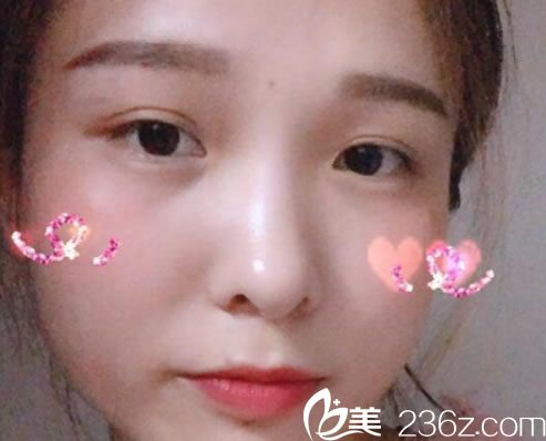 选择嘉兴曙光做埋线双眼皮30天后