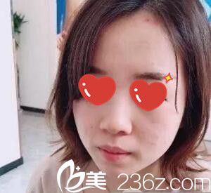 做鼻综合+假体垫下巴术前照 做鼻综合+假体垫下巴术前照