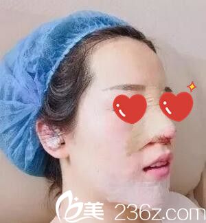 鼻综合+假体垫下巴术后天 鼻综合+假体垫下巴术后天