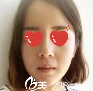 鼻综合+假体垫下巴术后一周效果 鼻综合+假体垫下巴术后一周效果